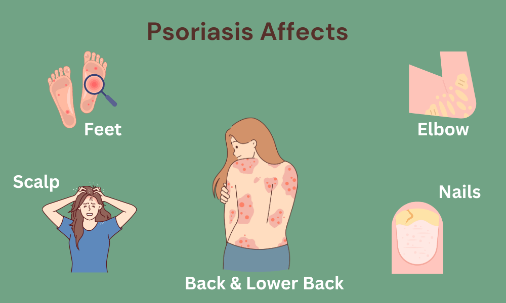 The Link Between Stress and Psoriasis