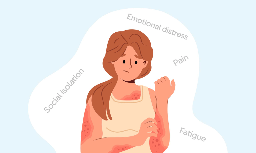 5 Simple Steps to Manage Psoriasis-Stress