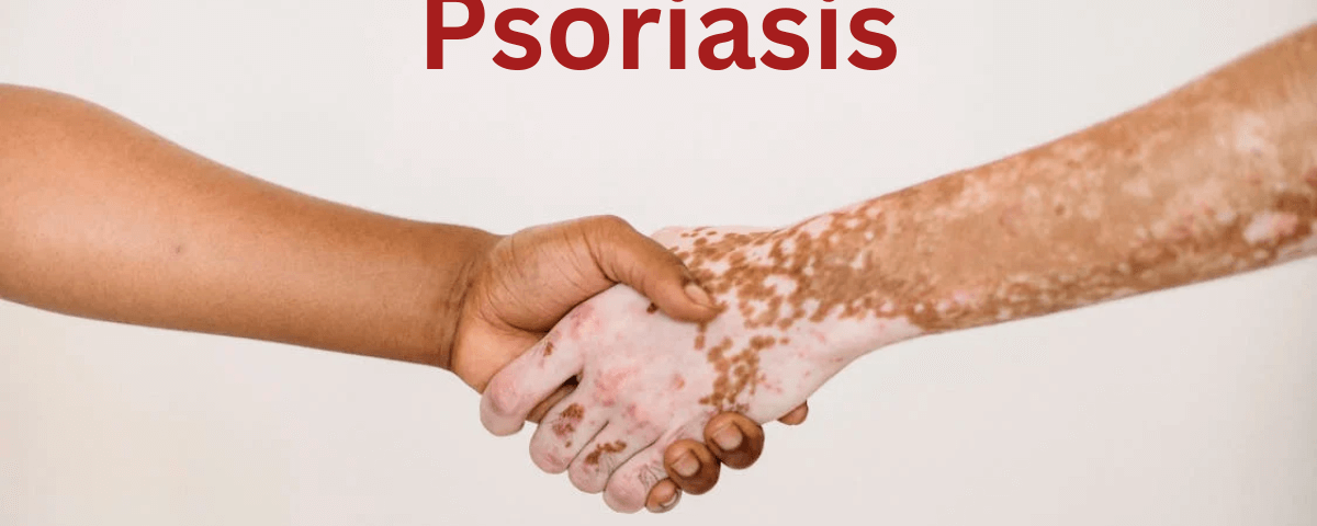 The Psoriasis-Stress Cycle: How Stress Fuels Psoriasis