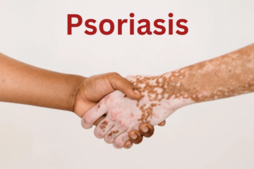 The Psoriasis-Stress Cycle: How Stress Fuels Psoriasis